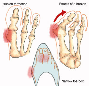 Juanete Formación Bunions