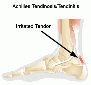 Achilles Tendonitis / Tendonosis