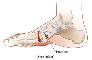 charcot foot