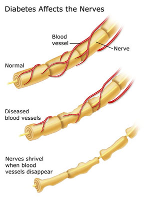 diabetic foot nerves