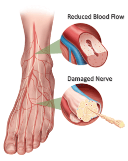 diabetic foot care