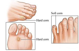 foot corns