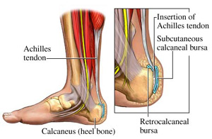 bursitis