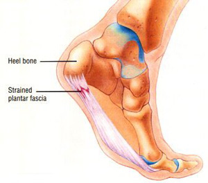 heel pain