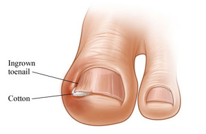 ingrown toenails