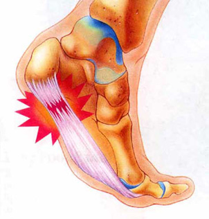 plantar fasciitis