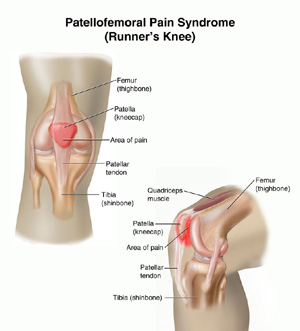 Chondromalacia or Runner’s Knee